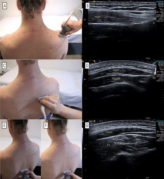 Estabilizadores escapula tempo formacion ecografia 1.jpg
